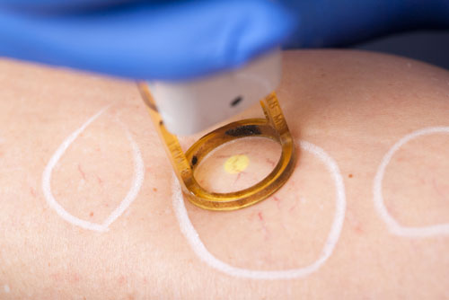spider vein removal
